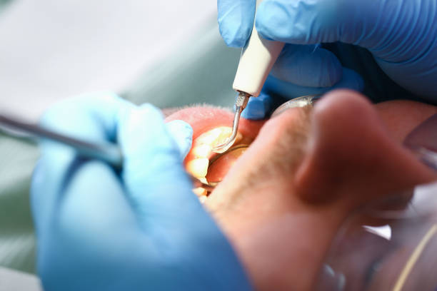Best Emergency Dental Care for Broken or Chipped Teeth in Kensington, CA