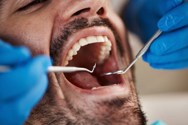 Best Urgent Care for Lost Fillings or Crowns in Kensington, CA